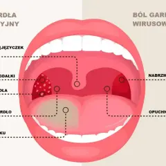 Ilustracja porównuje bakteryjne i wirusowe ostre zapalenie gardła, pokazując obrzęk, zaczerwienienie i nalot.