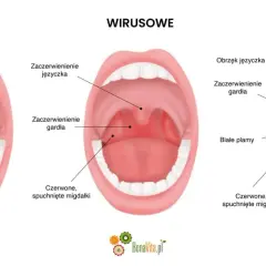Porównanie gardła dziecka: normalne, wirusowe i bakteryjne. Widoczne zaczerwienienie, obrzęk języczka, białe plamy i spuchnięte migdałki – objawy anginy.