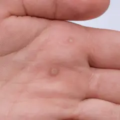 Dłoń mężczyzny z kilkoma brodawkami, które mogą być objawem wirusa HPV.