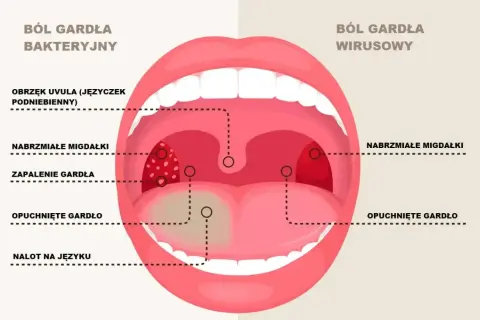 Ilustracja porównuje bakteryjne i wirusowe ostre zapalenie gardła, pokazując obrzęk, zaczerwienienie i nalot.