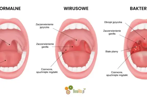 Porównanie gardła dziecka: normalne, wirusowe i bakteryjne. Widoczne zaczerwienienie, obrzęk języczka, białe plamy i spuchnięte migdałki – objawy anginy.