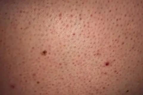 Widoczne liczne drobne krostki na ramionach, niektóre zaczerwienione, tworzące teksturę skóry.