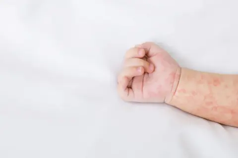 Różowa wysypka u dziecka na białym tle. Skóra na rączce jest zaczerwieniona i pokryta drobnymi plamkami.