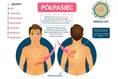 Ilustracja pokazuje, jak wygląda półpasiec: bolesna wysypka w formie pasa pęcherzy na tułowiu, spowodowana wirusem VZV.