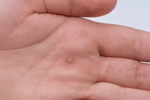 Dłoń mężczyzny z kilkoma brodawkami, które mogą być objawem wirusa HPV.