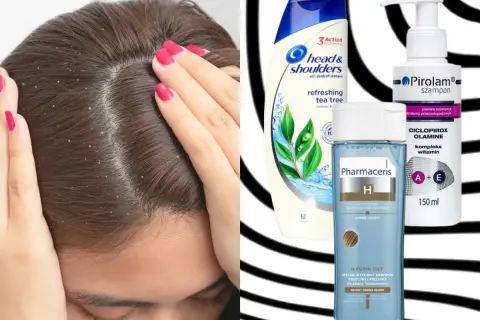 Jak pozbyć się łupieżu? Na zdjęciu widać skórę głowy z łupieżem i szampony przeciwłupieżowe: Head & Shoulders, Pirolam i Pharmaceris.