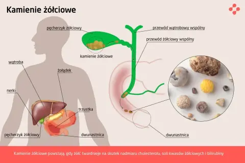 Ilustracja przedstawia pęcherzyk żółciowy z kamieniami żółciowymi. Widoczne są też wątroba, żołądek i dwunastnica.