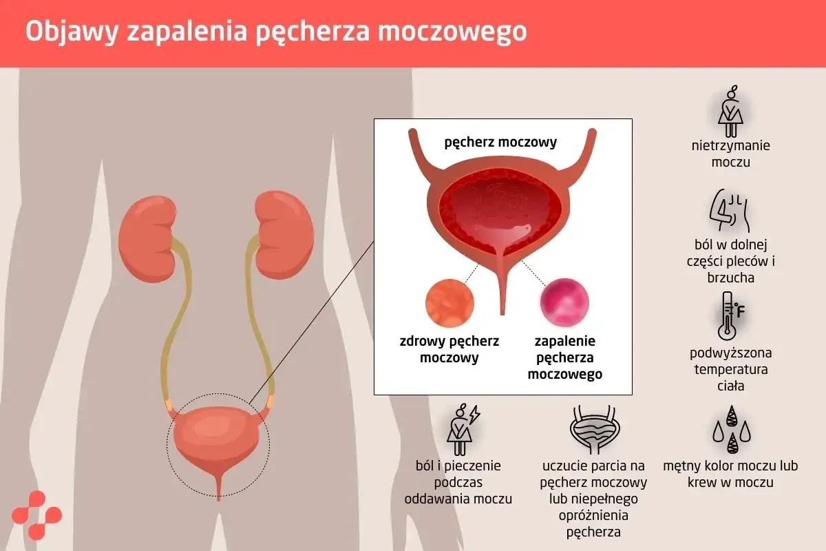 Zapalenie pęcherza - objawy i moment, gdy potrzebny jest lekarz
