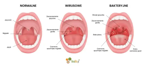 Angina u dziecka - Jak rozpoznać i kiedy potrzebny antybiotyk?